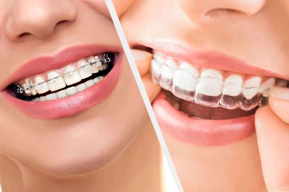 Orthodontie - alignement dentaire
